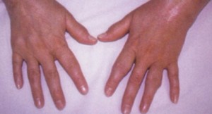 Articulations des doigts gonflées