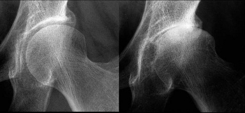 La coxarthrose primitive