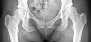 Radiographie de la coxarthrose secondaire