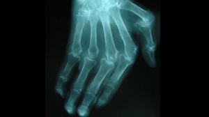 Radiographie main déformée