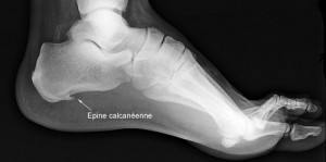 Radiographie d'une épine calcanéenne