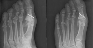 Radiographie d'une fracture d'un métatarse