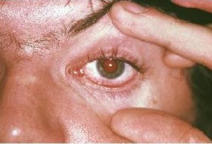 Inflammation de l'oeil