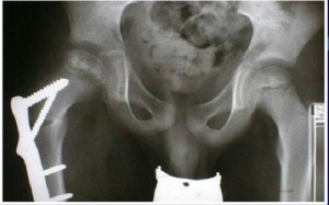 Ostéotomie du fémur