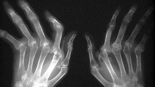 Radiographie déformation des mains dans une polyarthrite