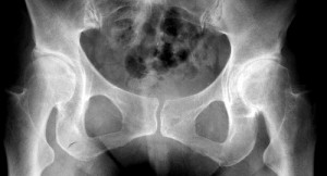 Radiographie de la coxarthrose