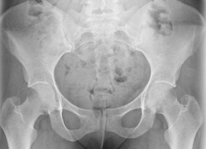 Radiographie des coxites de la hanche
