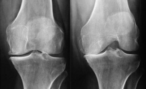 Radiographie de l'arthrose du genou