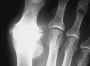 Radiographie hallux rigidus