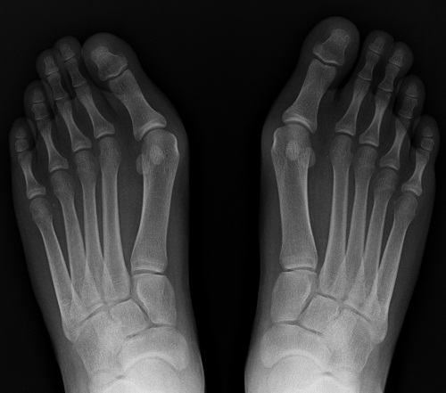 Radiographie hallux valgus