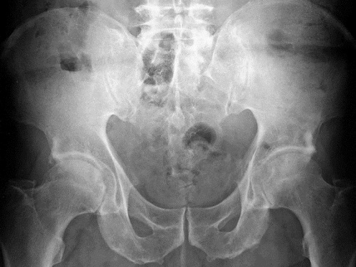 Diagnostic et traitement de la spondylarthrite ankylosante ...