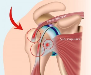 Rupture de tendons