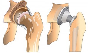 Schéma d'une prothèse de la hanche