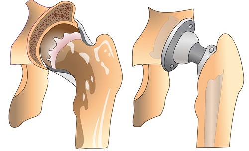 Schéma d'une prothèse de hanche