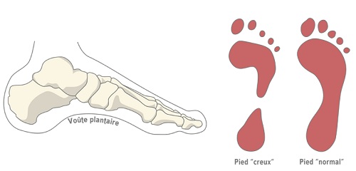 Pied creux et pied normal